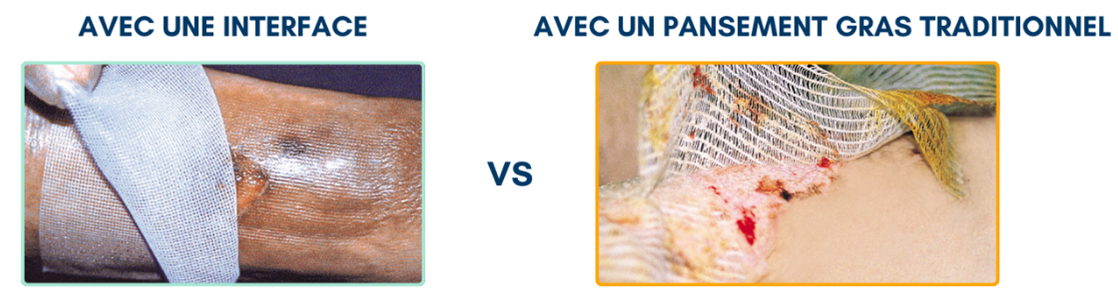 Comparatif pansement gras vs interface moderne